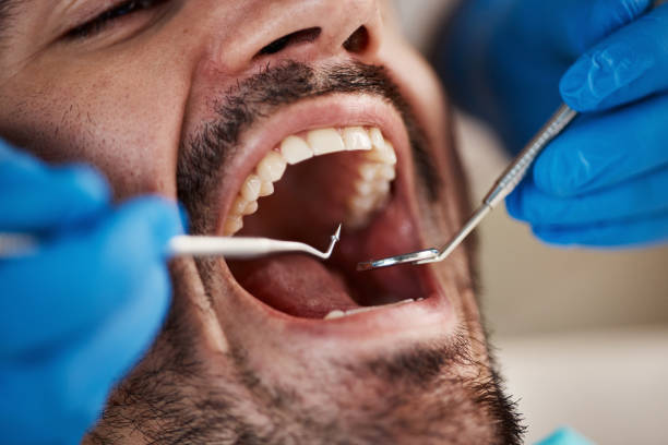 Best Emergency Treatment for Dental Infections or Abscesses in Nicholls, GA