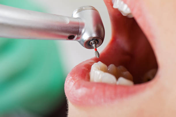 Best Emergency Tooth Extraction in Nicholls, GA